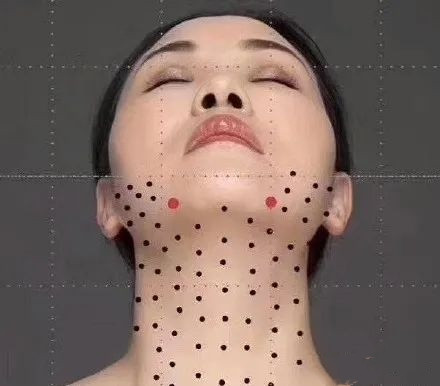 「案例分析」49歲的李女士，PSV面部提升後，脖子怎麼也變長了？