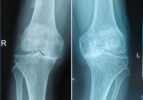 太極拳是否適合膝骨關節炎患者？起效時間需多久？