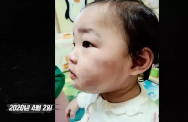 2020年,韓國女童被領養271天后被養父母虐殺,屍檢結果不忍細看 2020年,韓國女童被領養271天后被養父母虐殺,屍檢結果不忍細看