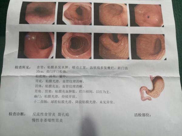 胃病患者，如何看“胃鏡報告單”