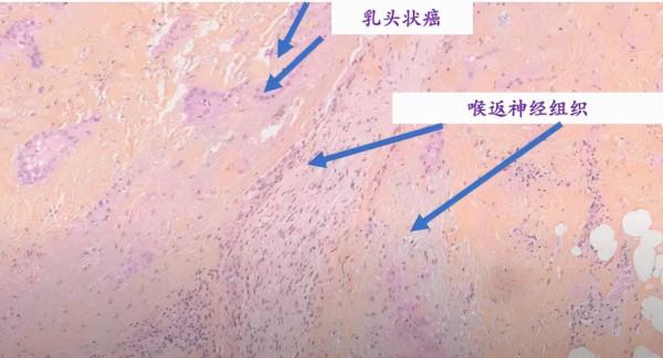 “小小”甲狀腺癌,竟引發慘劇 “小小”甲狀腺癌,竟引發慘劇