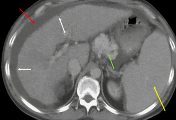 還沉迷於酒的世界嗎？天天喝酒有多可怕，快看看
