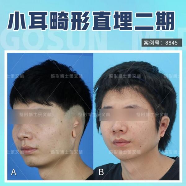 小耳畸形科普:用自體軟骨支架造的耳朵會繼續生長嗎? 小耳畸形科普:用自體軟骨支架造的耳朵會繼續生長嗎?