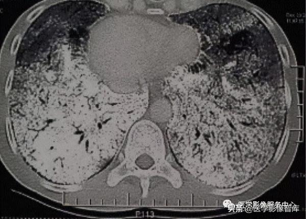 22個肺部疾病的CT徵象 22個肺部疾病的CT徵象
