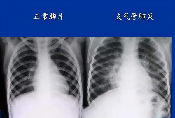 如何治療慢性支氣管炎？中醫和西醫兩者有區別