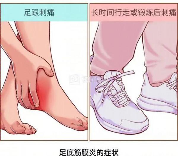 科普丨足底筋膜炎之“運動雖好，請適量”