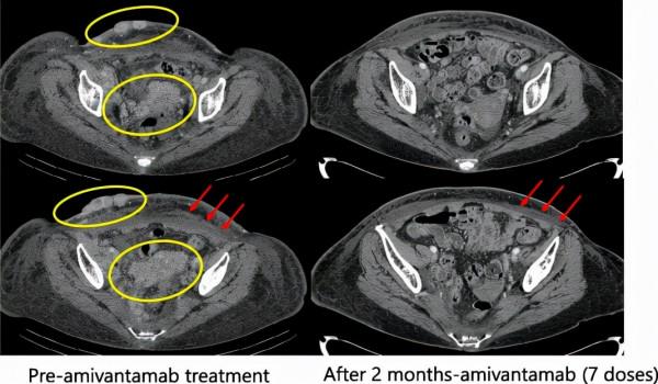 JNJ-6372單藥治療耐藥性EGFR突變肺癌快速有效