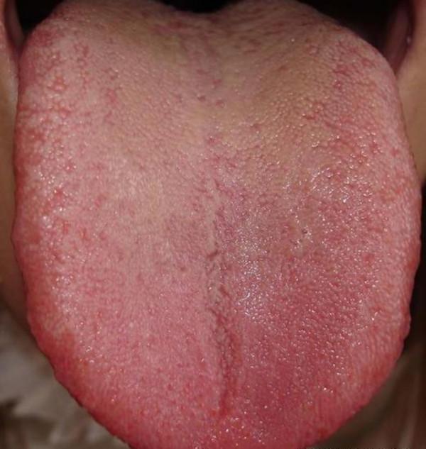 名老中醫嚴世芸特效方分享，辯證治療高血壓，對這些證型更有效