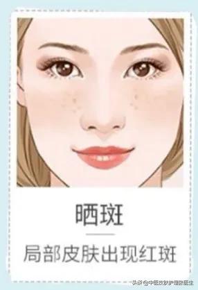 六大色斑最強攻略，教你如何科學祛斑，全是乾貨，建議收藏