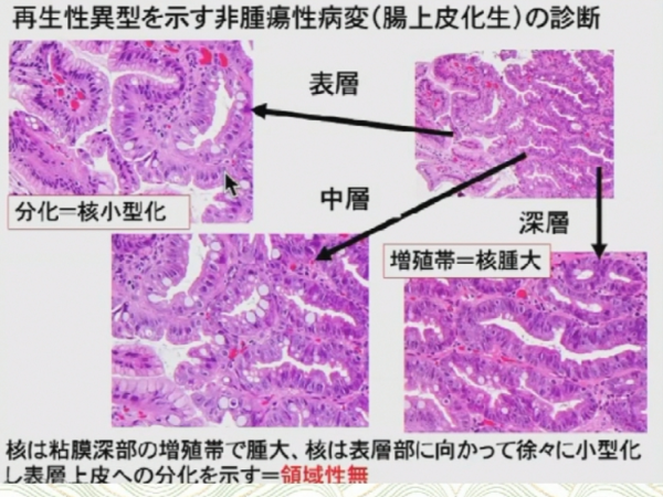 早期胃癌病理診斷：WHO VS.日本標準一文解析