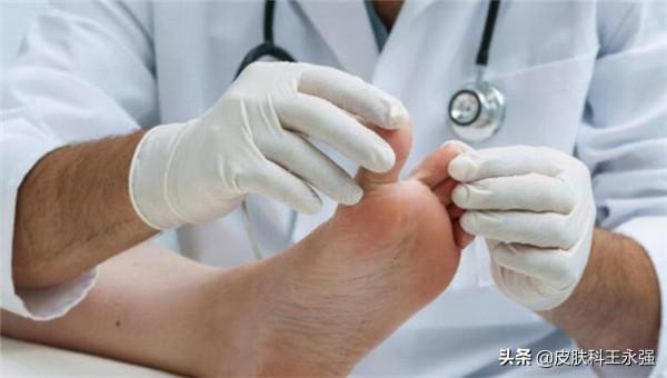 汗皰疹反覆性發作，瘙癢難耐，醫生教你用3個方法解決，快速有效