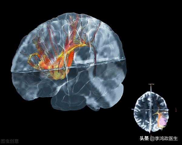 女子頭痛，經常聞到臭水溝味道，直到突然昏迷才發現腦袋長了個瘤
