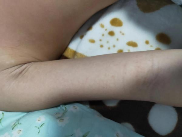 6歲寶寶接種新冠疫苗後