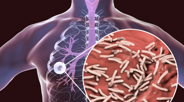 什麼是“肺大皰”？體檢時被查出該怎麼辦？呼吸科醫生道出了真相