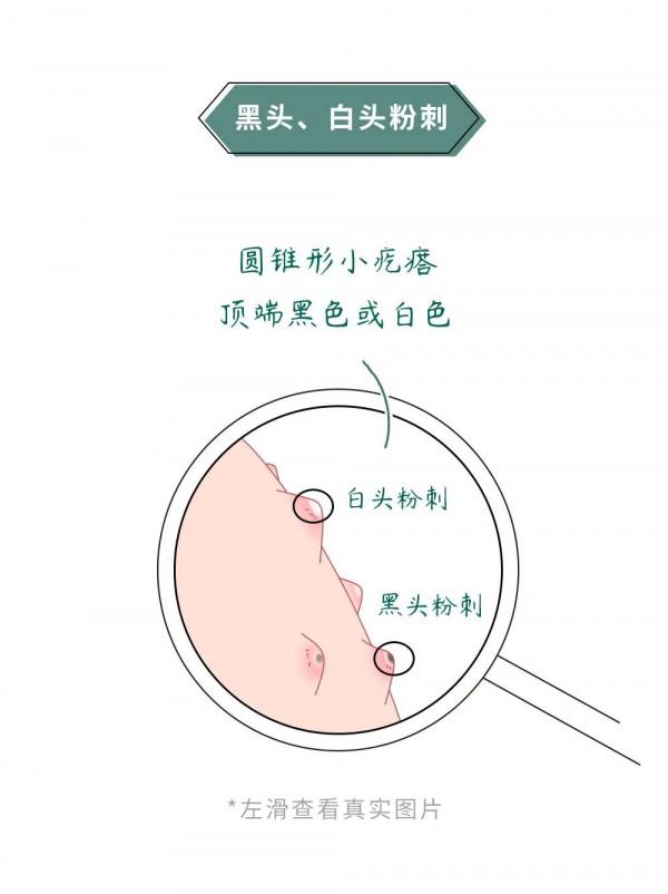 漫畫科普：“揹負”太多，“疹”的很累！