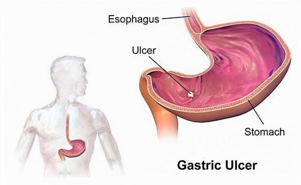 世衛組織公佈的致癌清單:除了“中式鹹魚”,這3種食物也要少吃 世衛組織公佈的致癌清單:除了“中式鹹魚”,這3種食物也要少吃