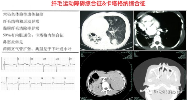 反覆發作鼻竇炎、咳嗽、支氣管擴張,這個病我們要提高認識 反覆發作鼻竇炎、咳嗽、支氣管擴張,這個病我們要提高認識