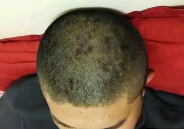 為什麼頭皮總長“疙瘩”和“膿包”？或許跟這4個因素有關