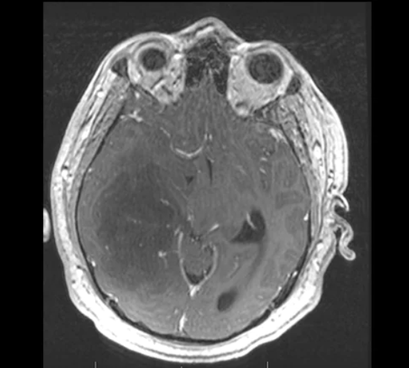 9種腦部病變,一文識別丨臨床必備 9種腦部病變,一文識別丨臨床必備