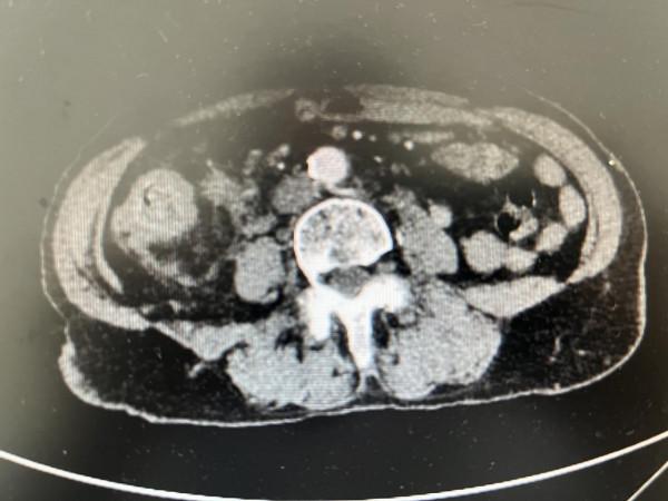 河南省人民醫院胃腸外科李丹主任團隊成功救治一名結腸癌晚期患者 河南省人民醫院胃腸外科李丹主任團隊成功救治一名結腸癌晚期患者