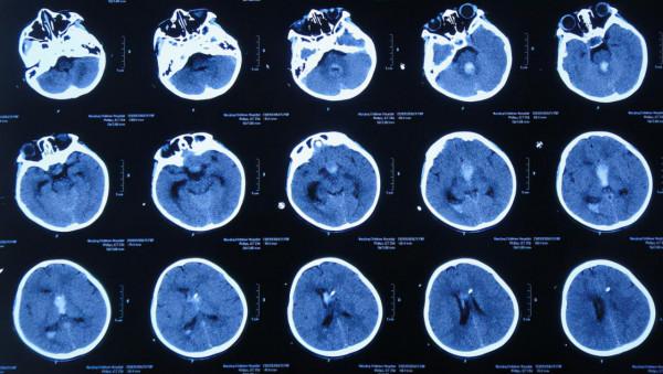 顱內生殖細胞瘤切除術後腦積水仍反覆,意識模糊,左側肢體偏癱 顱內生殖細胞瘤切除術後腦積水仍反覆,意識模糊,左側肢體偏癱