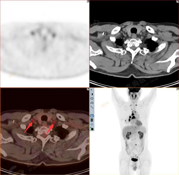 肺結節看診（13）：肺小結節全身廣泛轉移2例，PET分期：晚期