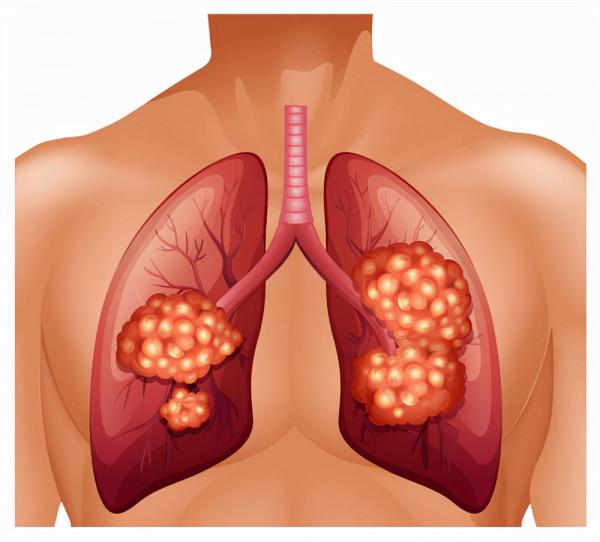 網友問:3mm的肺結節,不治療可以嗎? 網友問:3mm的肺結節,不治療可以嗎?