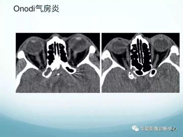 頭頸五官CT斷層解剖圖及常見病影像診斷