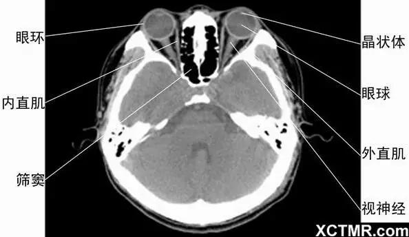 頭頸五官CT斷層解剖圖及常見病影像診斷