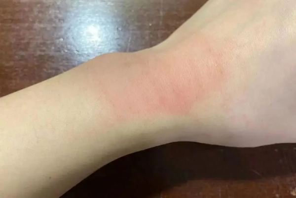 哪兒痛貼哪兒?錯!膏藥不是這麼用的! 哪兒痛貼哪兒?錯!膏藥不是這麼用的!