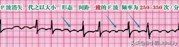 這樣教你看心電圖,沒有理由看不懂 這樣教你看心電圖,沒有理由看不懂
