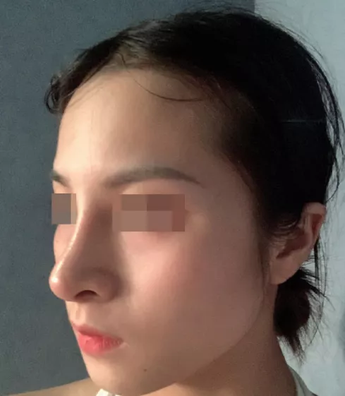 韋敏科普丨為什麼假體隆鼻,高度不能隨心所欲? 韋敏科普丨為什麼假體隆鼻,高度不能隨心所欲?