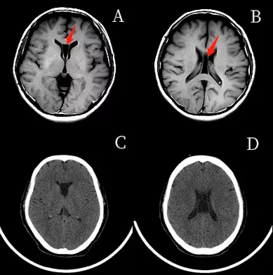 “第五腦室”是透明隔腔嗎? “第五腦室”是透明隔腔嗎?