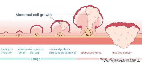 最常見5類息肉每個人都可能有，哪些無癌變風險，哪些需要切除？