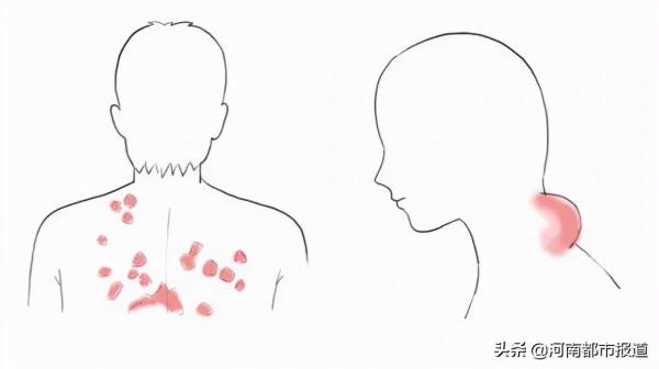 熬夜、無肉不歡、夜宵無限制，30歲的他脖子長出“鵝蛋”