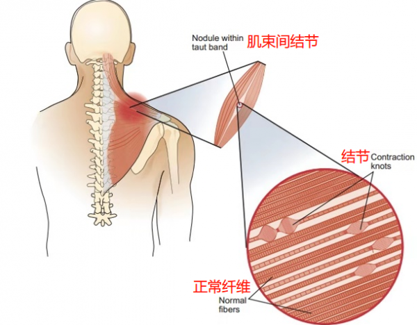 什麼是肌肉筋膜粘連?難道會造成運動損傷?健身的你需要了解 什麼是肌肉筋膜粘連?難道會造成運動損傷?健身的你需要了解