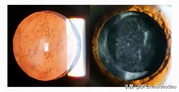 白內障手術應該如何選擇人工晶體?人工晶體有什麼不同 白內障手術應該如何選擇人工晶體?人工晶體有什麼不同