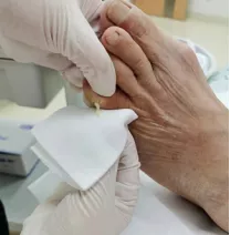 25年痛風病史，全身多處痛風石，疼痛難忍的痛風還能這麼治