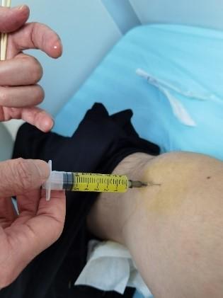 &OpenCurlyDoubleQuote;一針扎進去，關節液自動流出來了&rdquo;，過完年，這種病又開始發作了