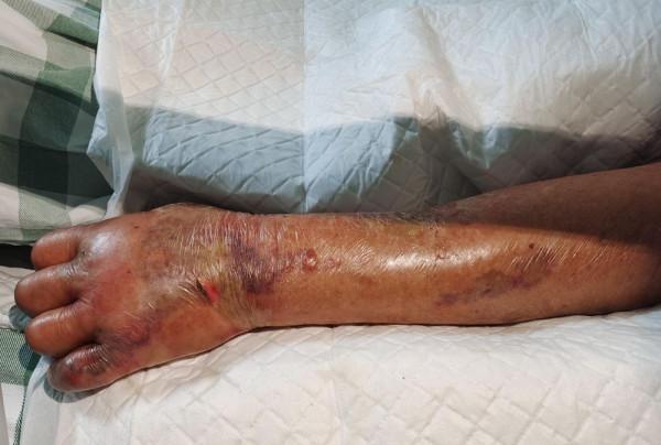 八旬老人洗蝦手指被刺,竟得切除左上肢來保命 八旬老人洗蝦手指被刺,竟得切除左上肢來保命