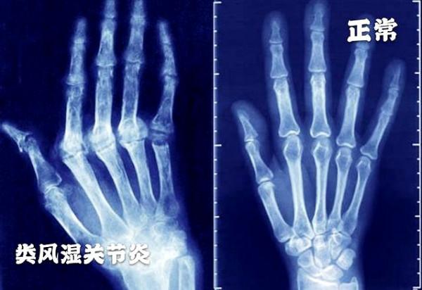 五十多歲的女性們，您有晨起手指僵硬、疼痛，甚至變形的現象嗎？