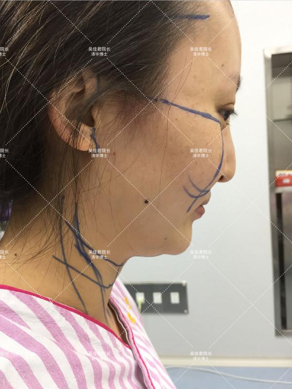 32歲公開做小拉皮+頸闊肌成形手術全過程,速來圍觀 32歲公開做小拉皮+頸闊肌成形手術全過程,速來圍觀