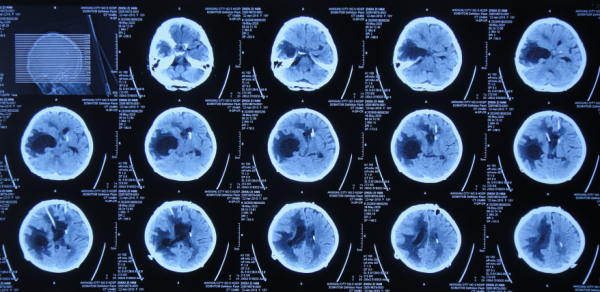 顱內生殖細胞瘤切除術後腦積水仍反覆,意識模糊,左側肢體偏癱 顱內生殖細胞瘤切除術後腦積水仍反覆,意識模糊,左側肢體偏癱