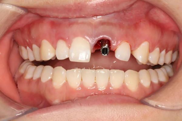 同仁醫線丨精準種植，美學修復，再也不用愁眉苦臉了