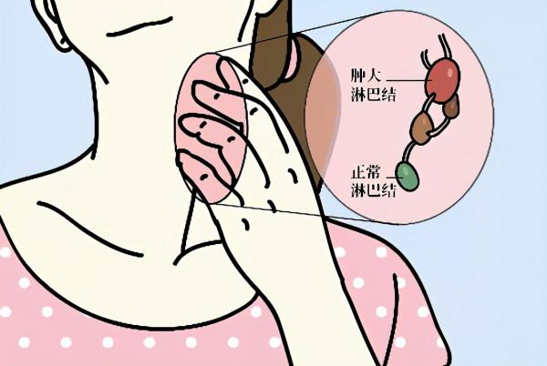 頸部淋巴結突然腫大是不祥之兆?醫生說有這些症狀最危險 頸部淋巴結突然腫大是不祥之兆?醫生說有這些症狀最危險