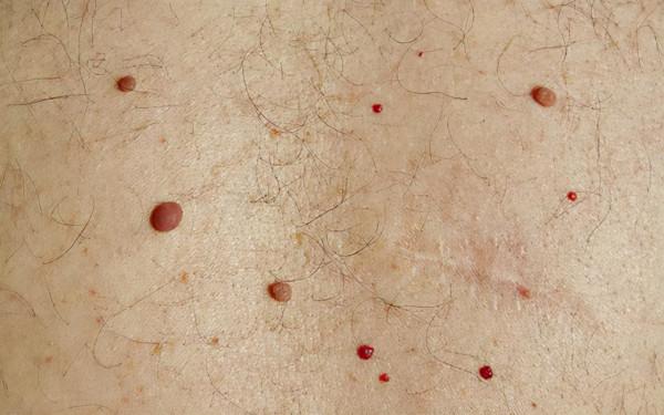 什麼是皮下出血？皮下出血是紫癜嗎？