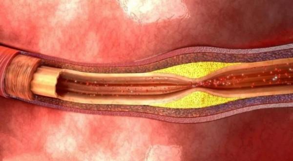 點按三個部位疏通瘀堵心血管