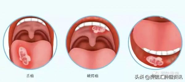 檳榔害我變成了“割臉人”(二) 檳榔害我變成了“割臉人”(二)