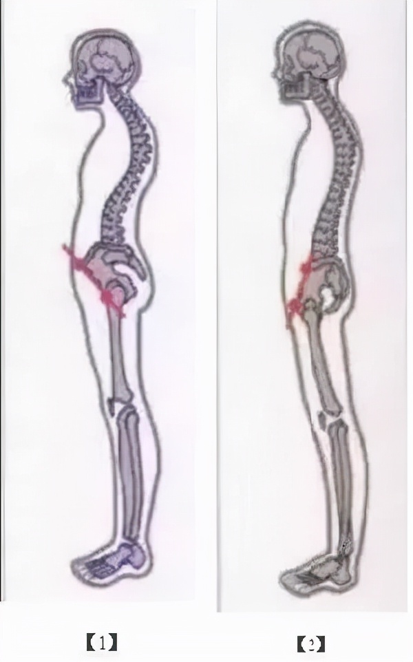 太極拳治含胸駝背頭前伸 太極拳治含胸駝背頭前伸