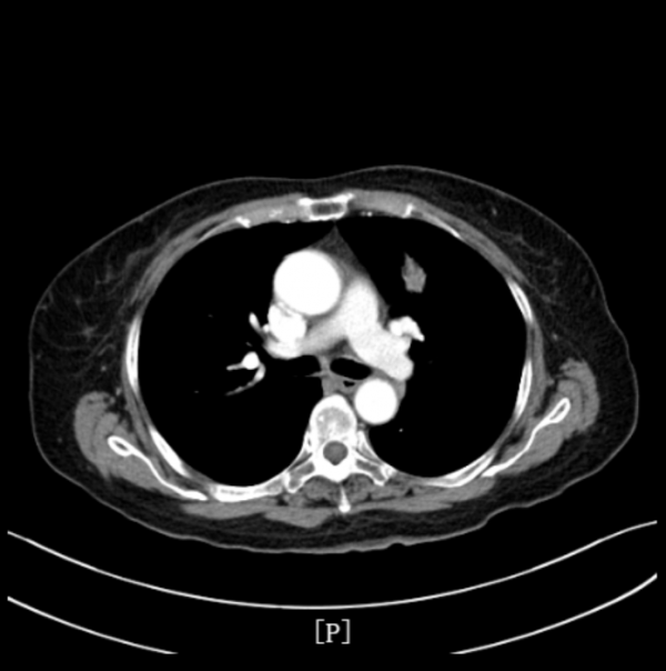 百例徵優 | 貝伐珠單抗聯合化療——為晚期肺癌多發轉移患者帶來新希望